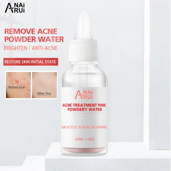 Hot selling Treatments acne scar removal acne serum Beauty drying lotion acne cream