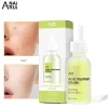 Private Label Acne Treatment Serum