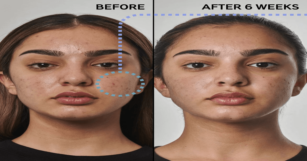 Benzoyl Peroxide Skin Care