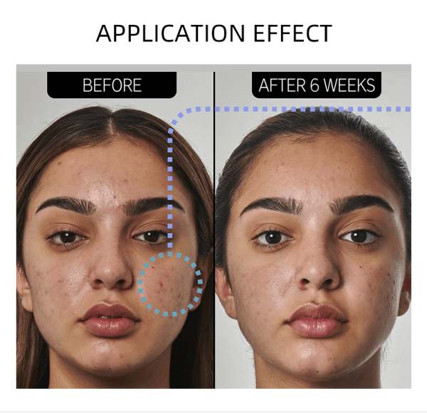 Specially designed to combat acne and breakouts