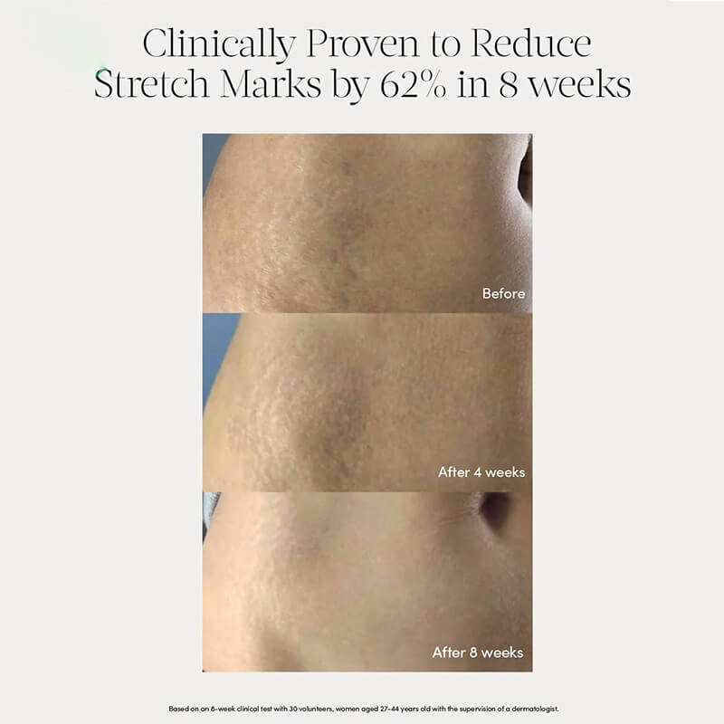 private label natural repair pregnancy women scar removal belly serum