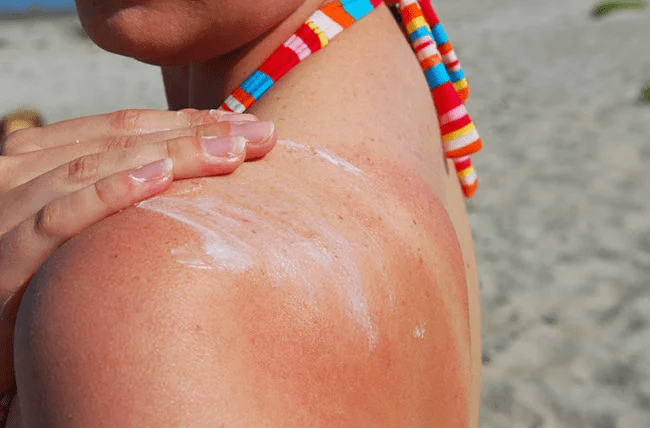 chronic excessive uv exposure
