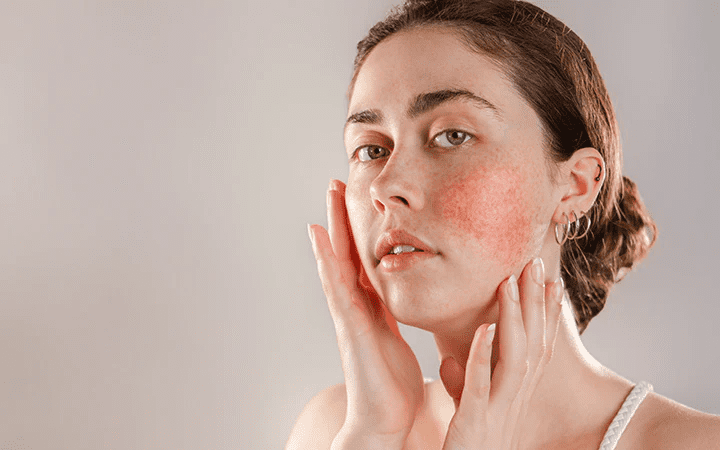 skin inflammation