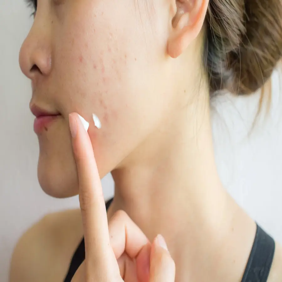 azelaic acid common acne