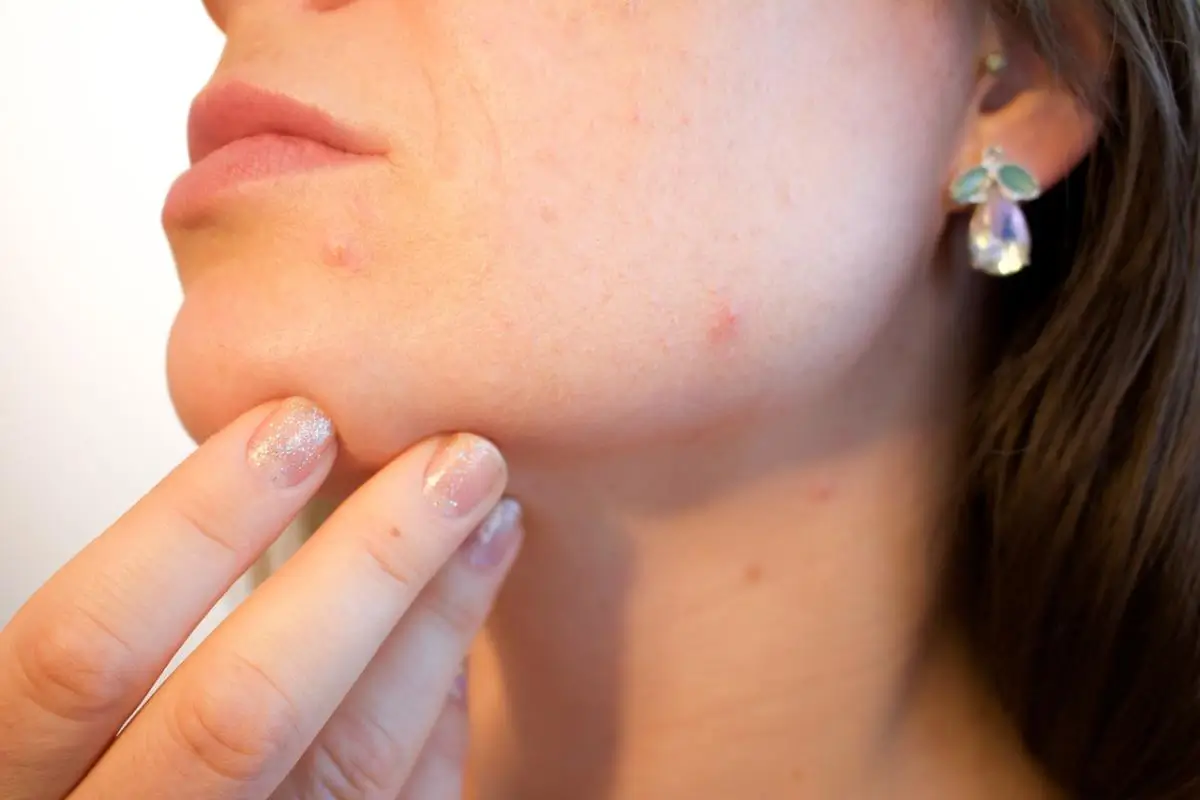causes of acne
