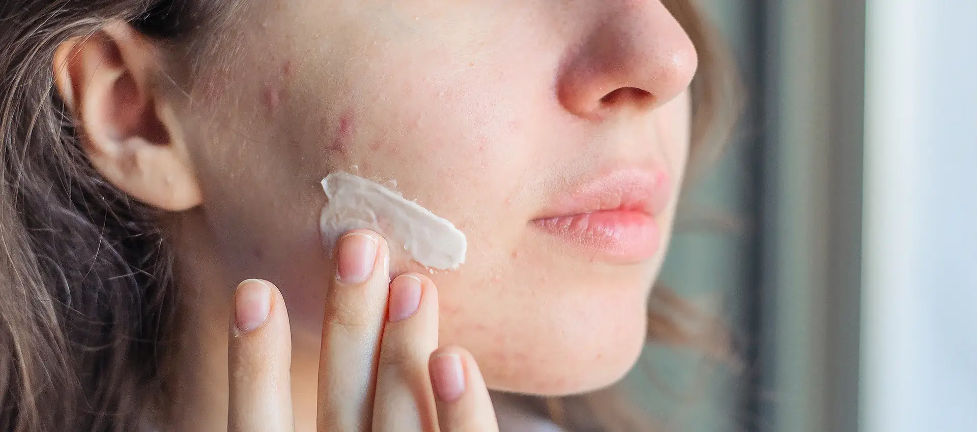 clogged pores