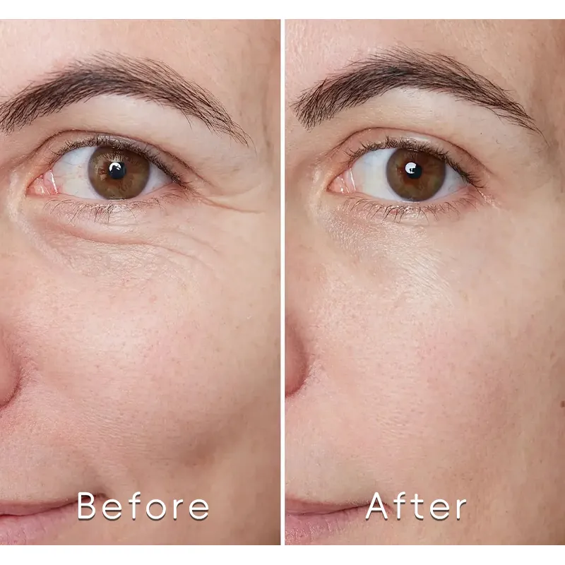 Image shows a person's face with only a portion of the eyebrows, eyelids, and section of the skin visible, while the rest is blurred out.