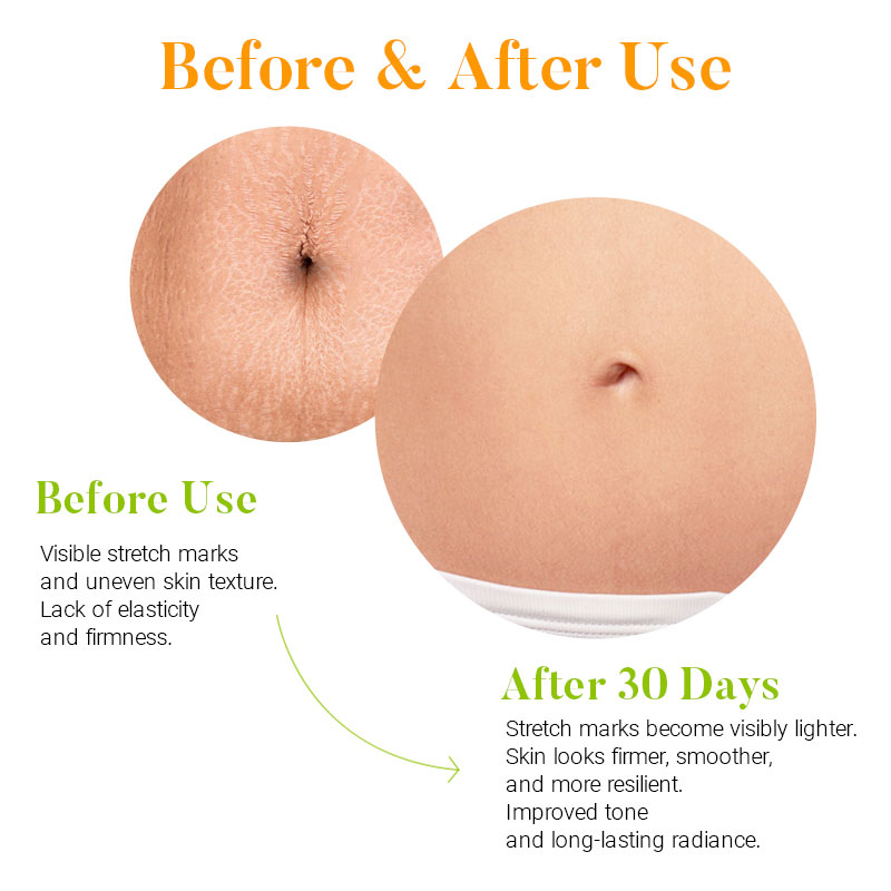 private label stretch mark removal kit effectively removes stretch marks