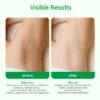Comparison of underarm skin before and after treatment showing improved tone and texture.