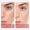 Close-up shows skin condition before treatment on the left and blurred overlay on the right side. Highlights facial redness and scabbing.