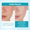 Comparison of facial skin before and after treatment showing reduced redness, smoother texture, and hydrated appearance.
